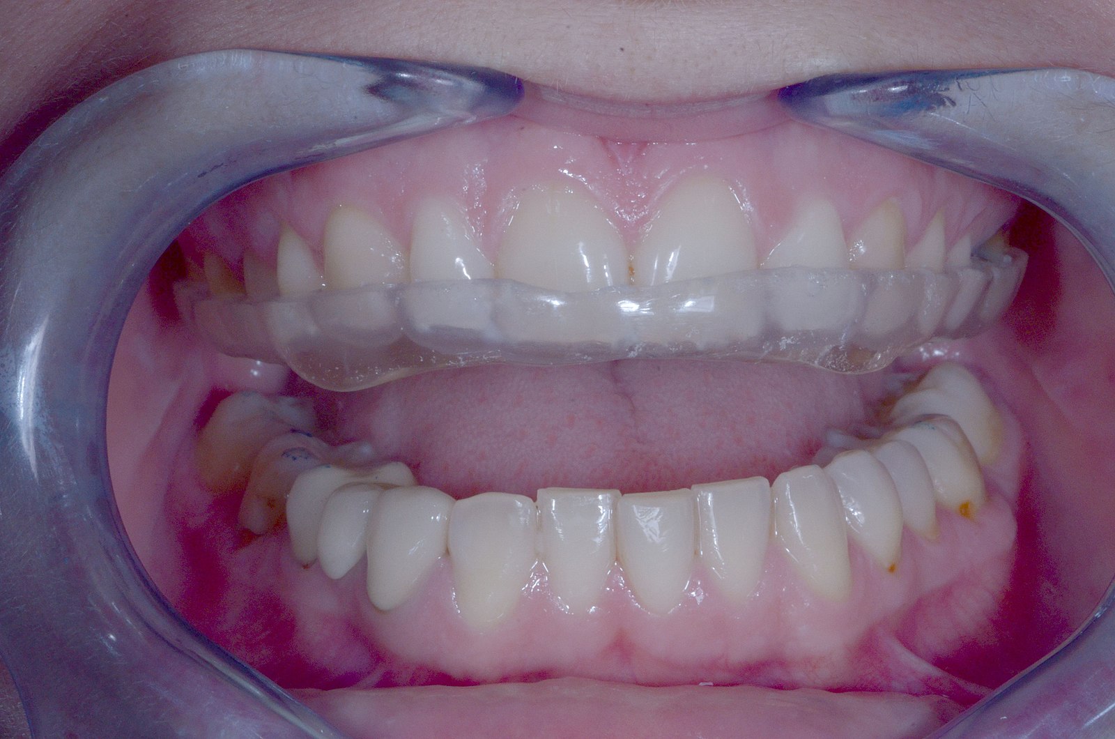 Bruxismo: apretar los dientes sin necesidad